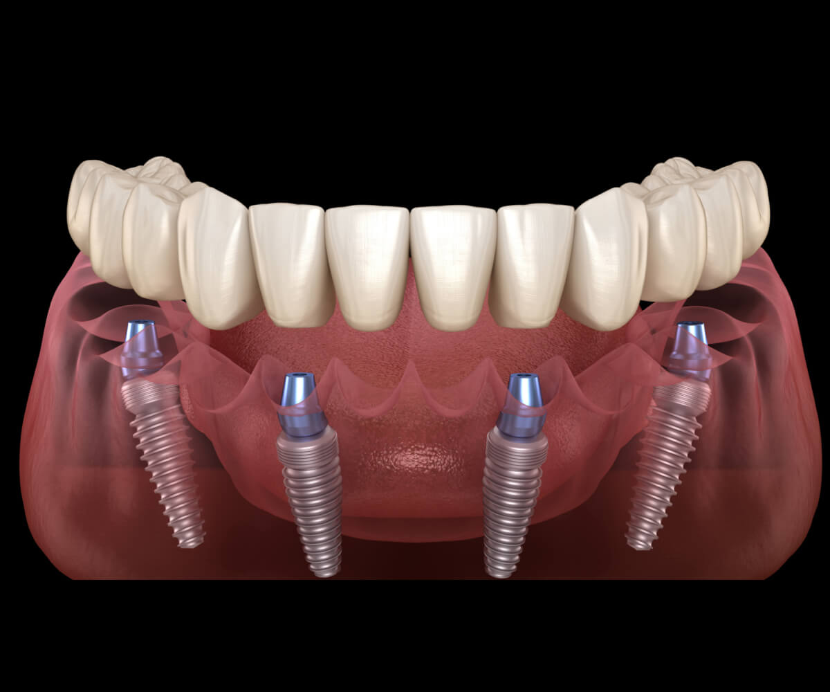 All Teeth On 4 Implants