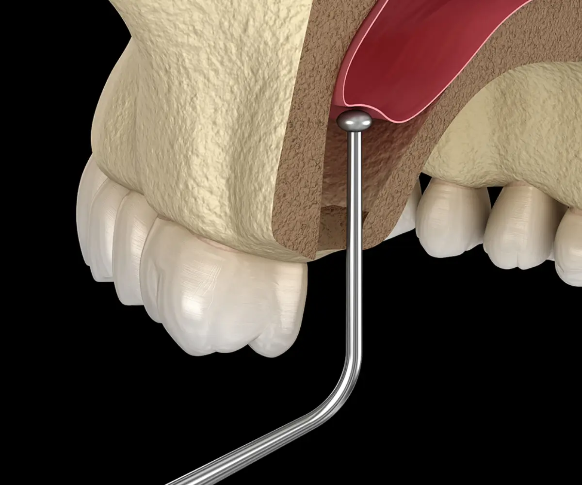 Bone Grafts And Sinus Lifts