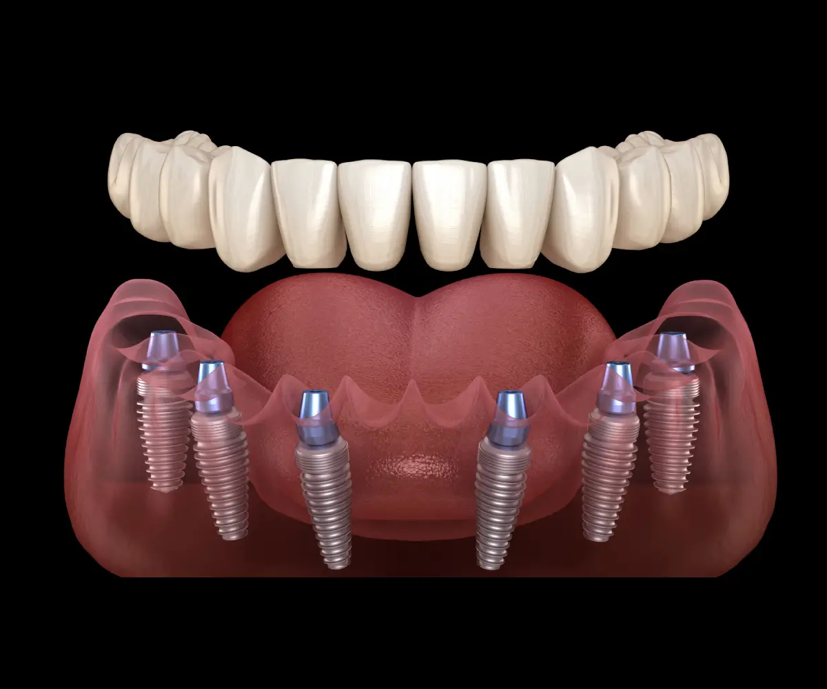 Full Mouth Dental Implants