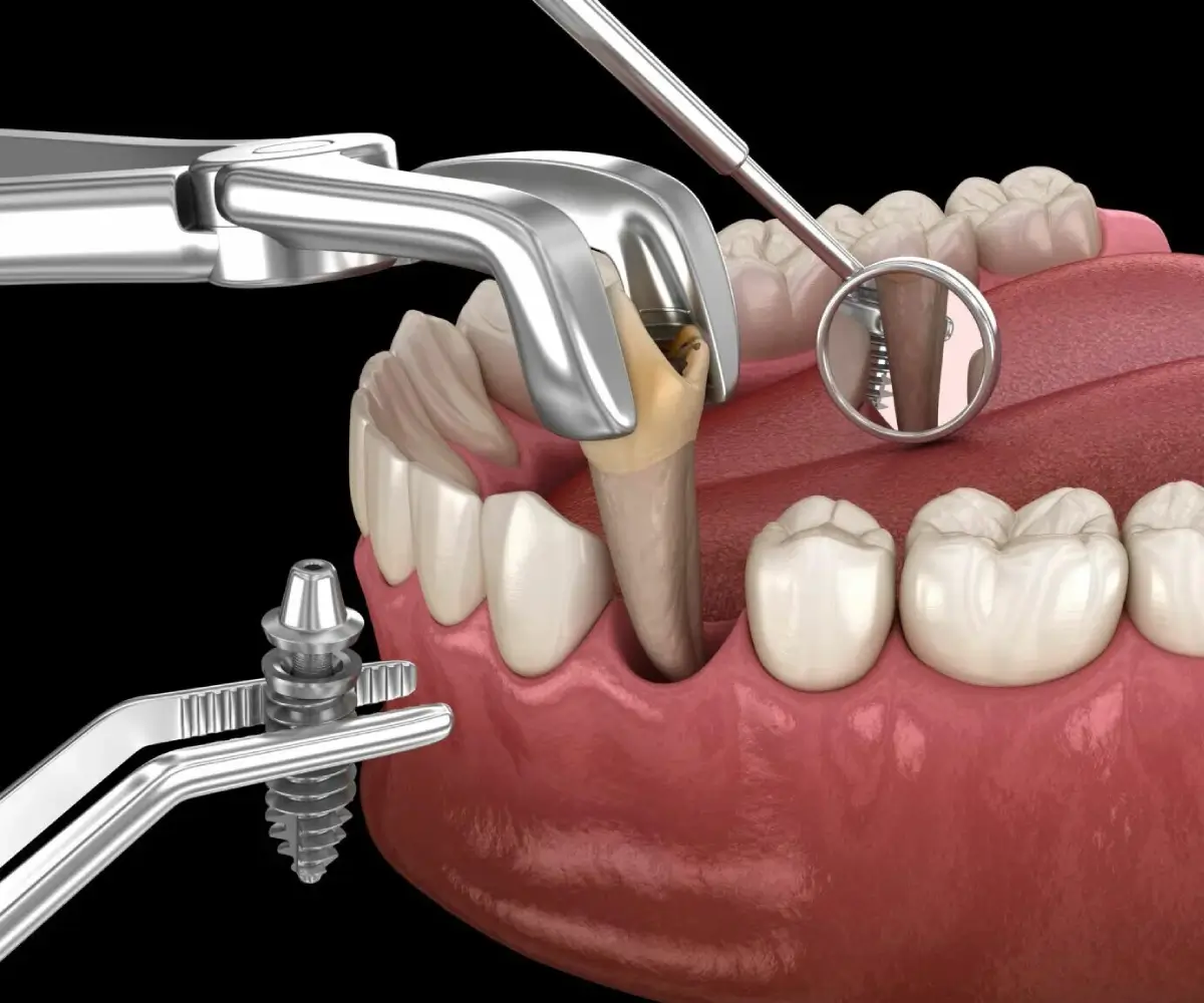Immediate Dental Implants