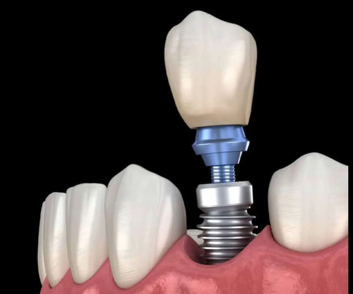 Single & Multiple Implants